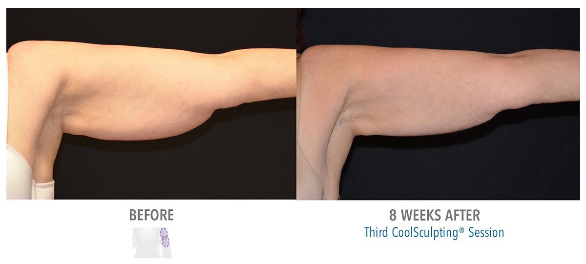 before and after coolsculpting for arm fat hendersonville