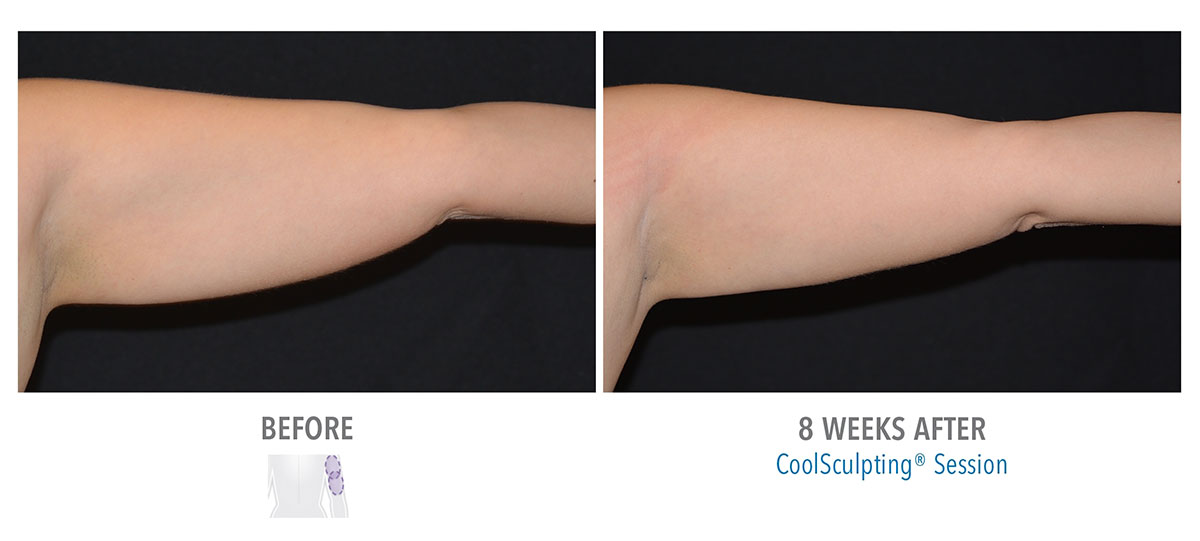 before and after coolsculpting for arm fat hendersonville