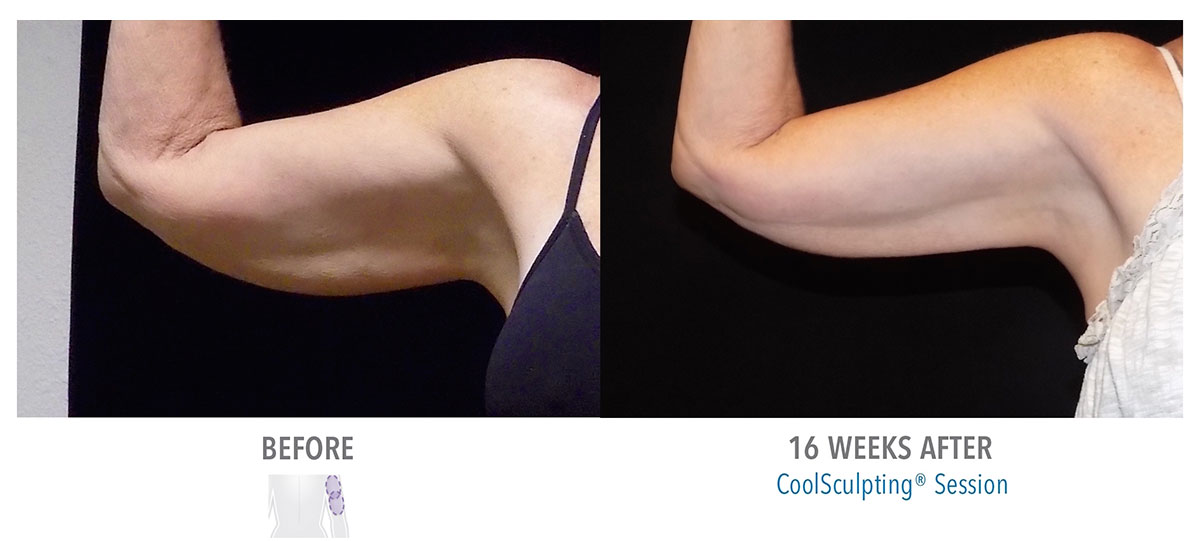 before and after coolsculpting