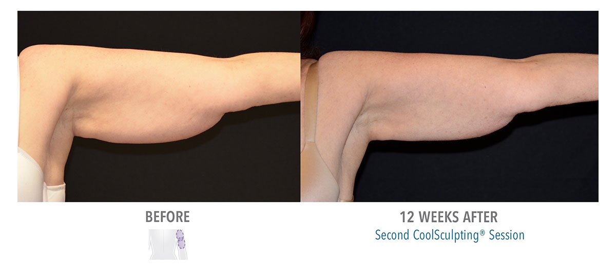 before and after coolsculpting