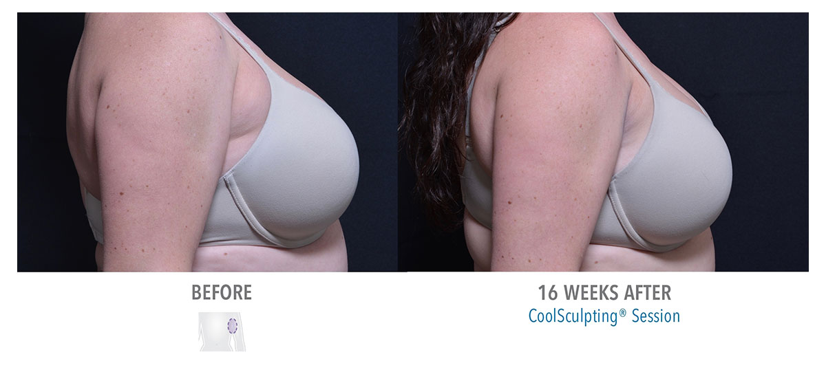 before and after coolsculpting