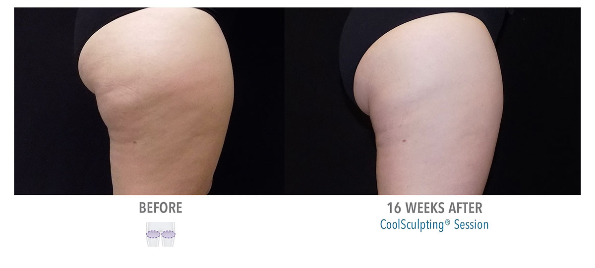 before and after coolsculpting