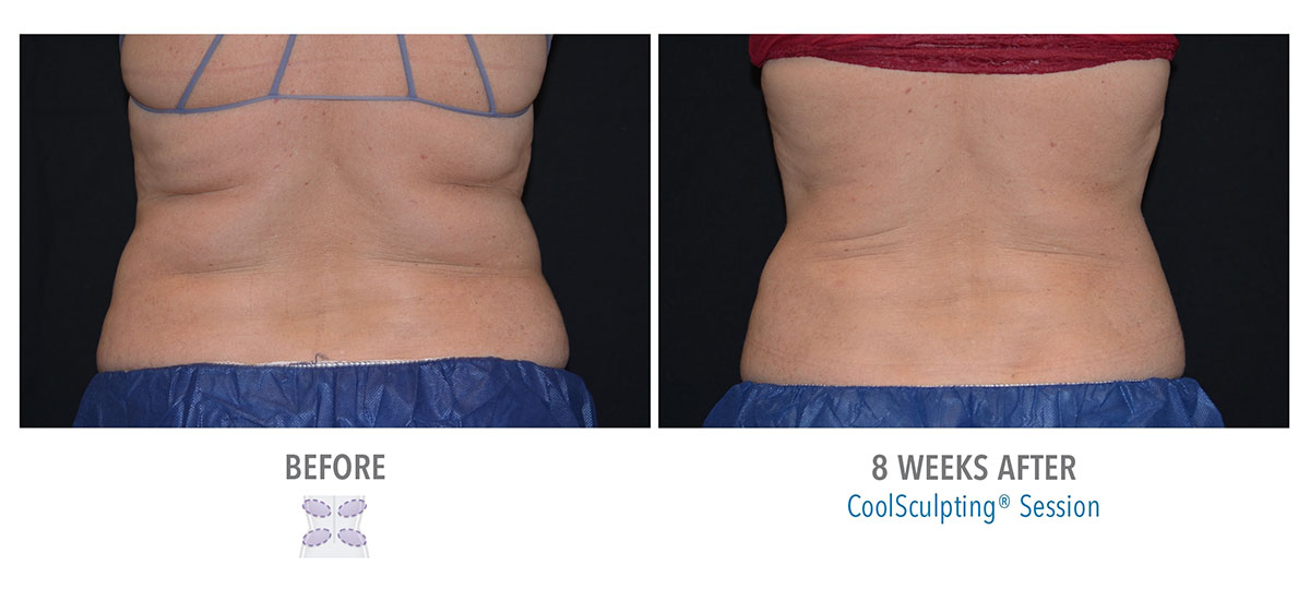 before and after coolsculpting on back fat hendersonville