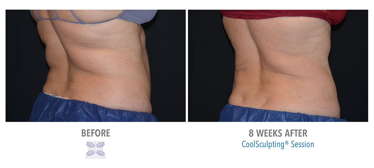 before and after coolsculpting