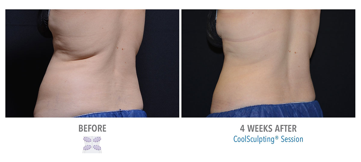 before and after coolsculpting