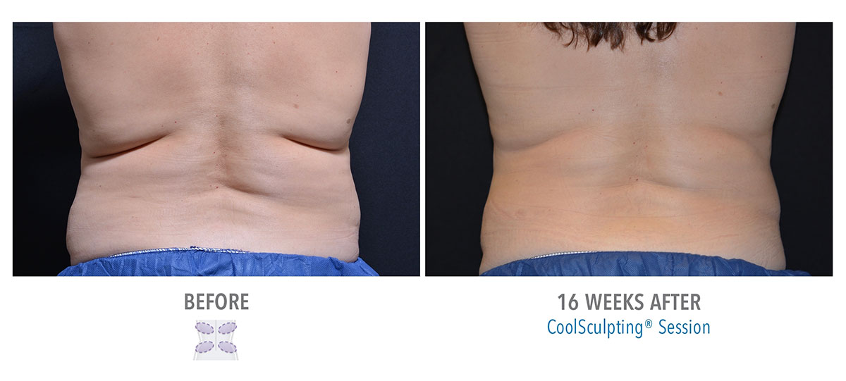 before and after coolsculpting on back fat hendersonville