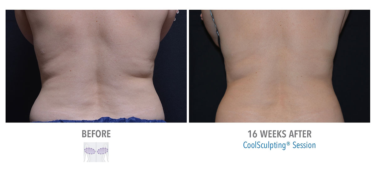 before and after coolsculpting