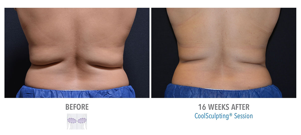 before and after coolsculpting