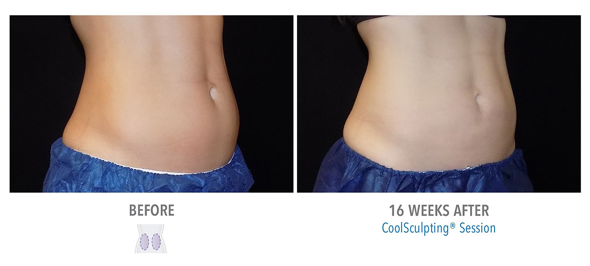 before and after coolsculpting