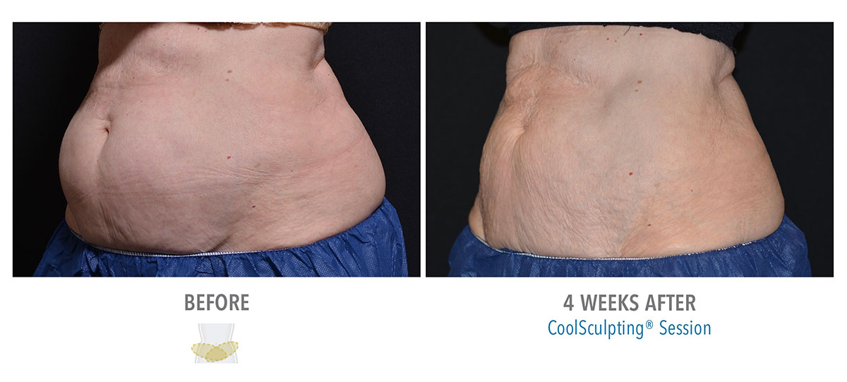 before and after coolsculpting