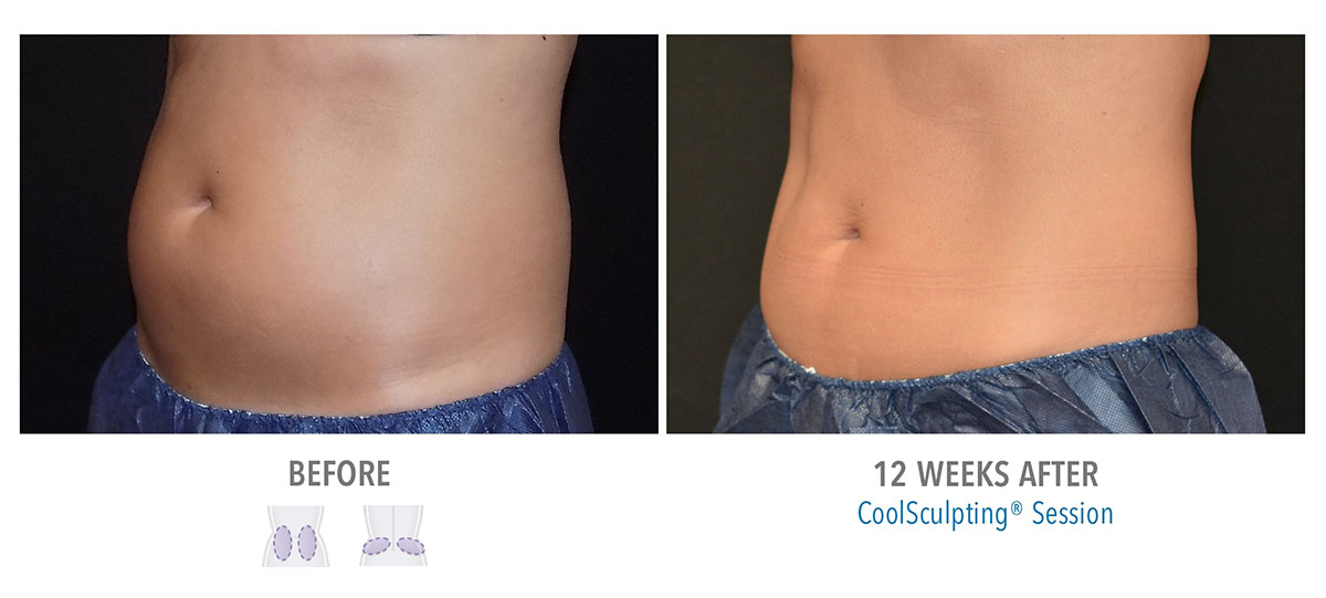 before and after coolsculpting