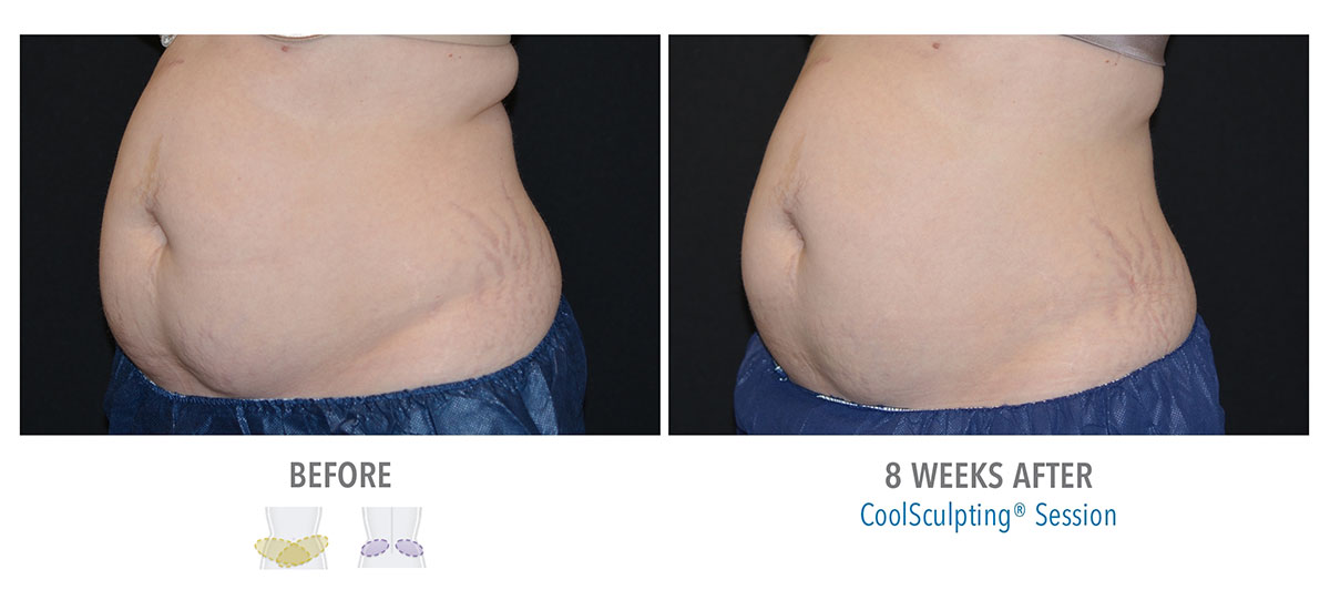 before and after coolsculpting