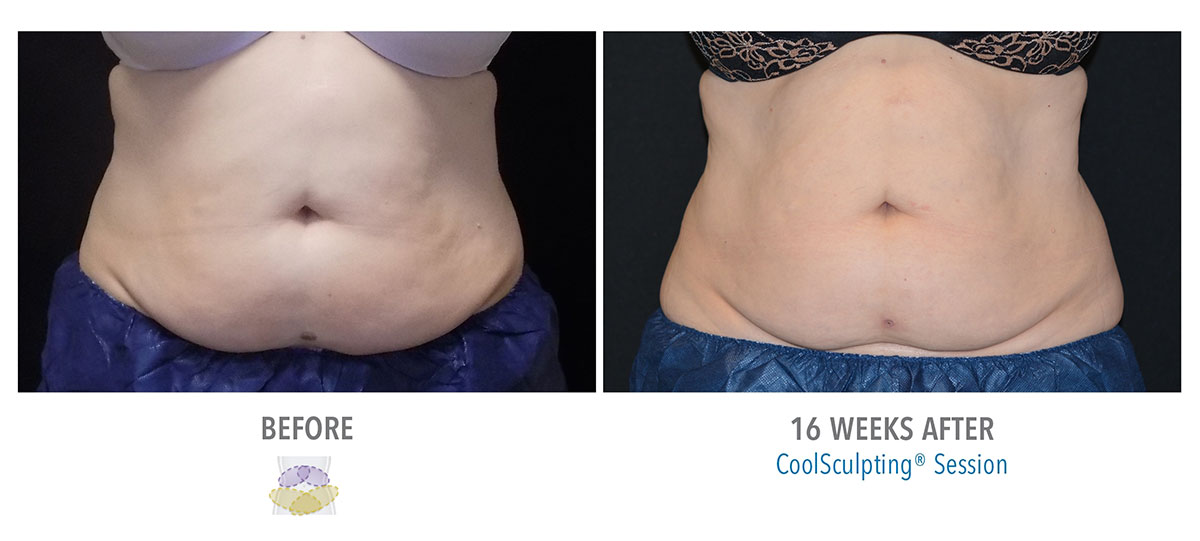 before and after coolsculpting