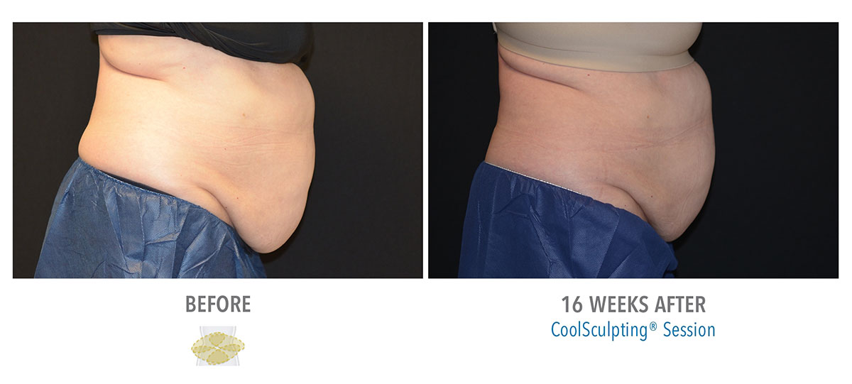 before and after coolsculpting