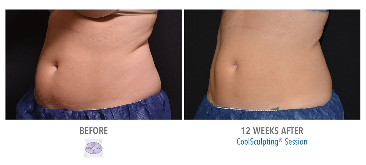 before and after coolsculpting