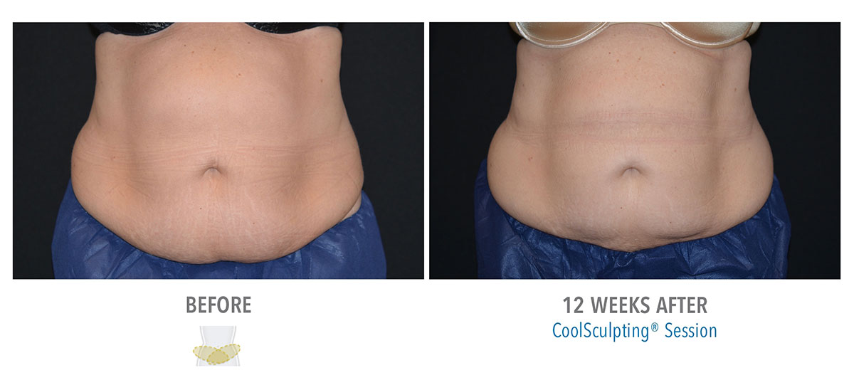 before and after coolsculpting