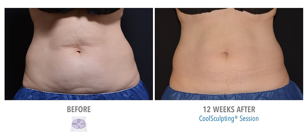 before and after coolsculpting