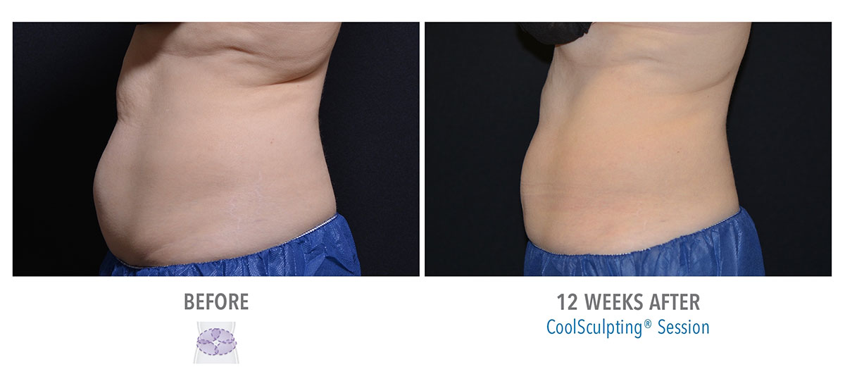 before and after coolsculpting