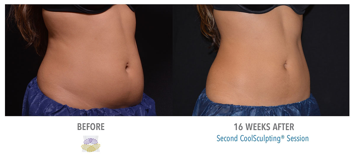 before and after coolsculpting