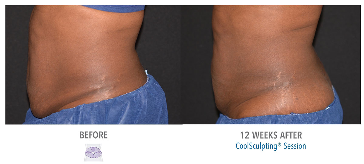 before and after coolsculpting