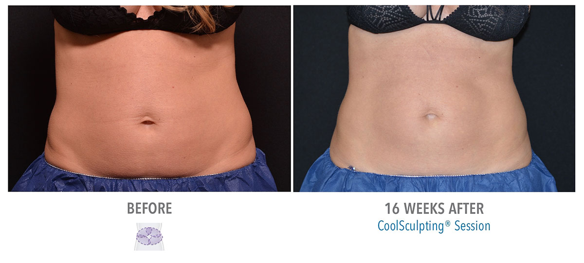 before and after coolsculpting