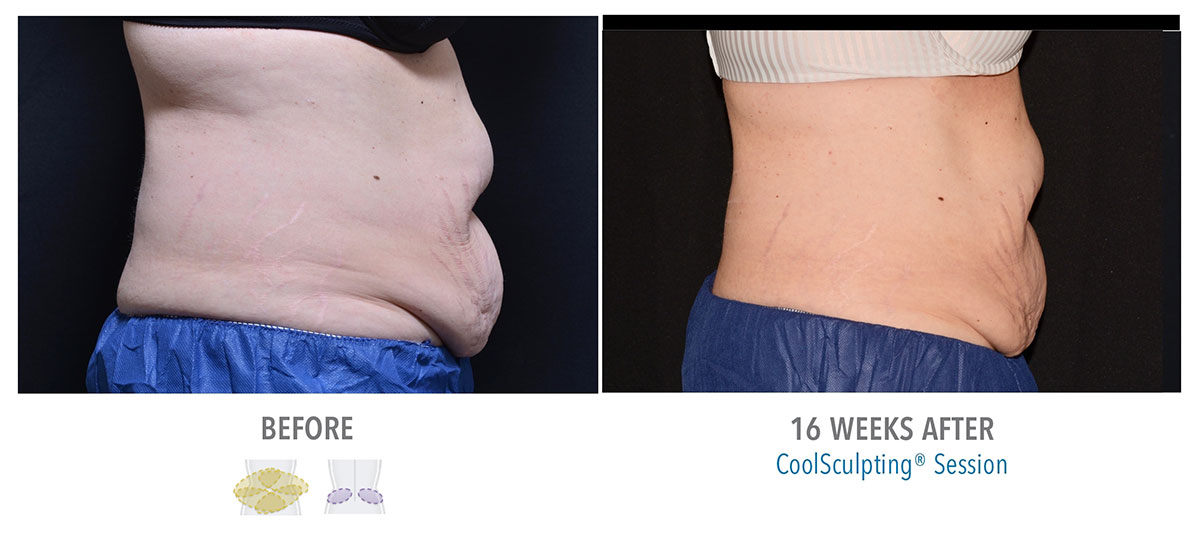 before and after coolsculpting