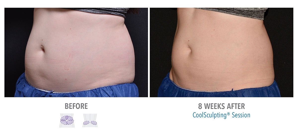 before and after coolsculpting