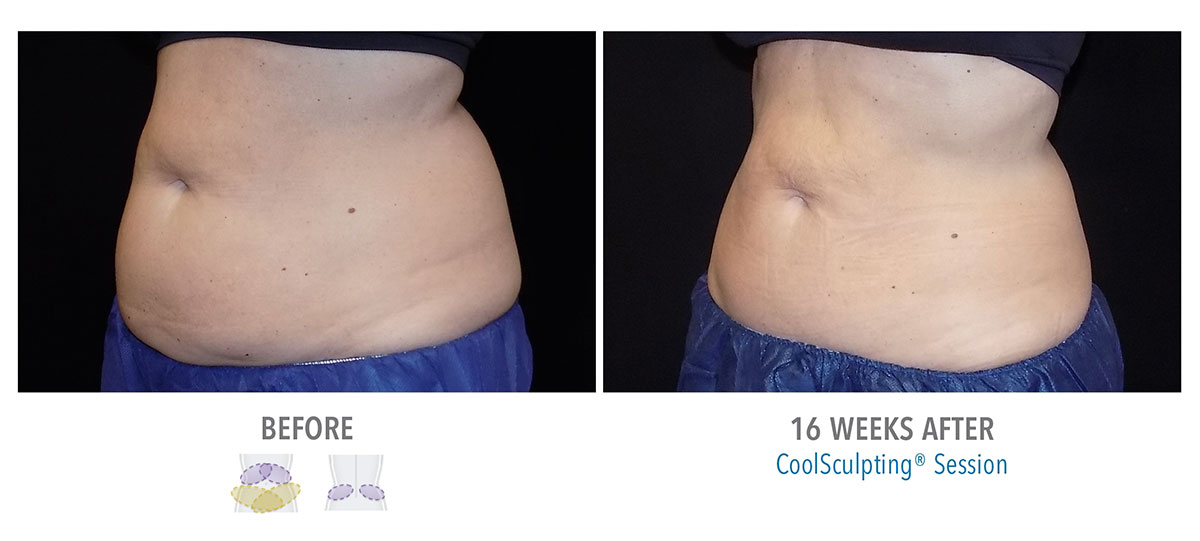 before and after coolsculpting