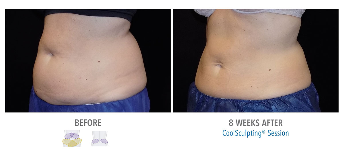 before and after coolsculpting