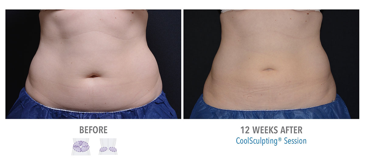 woman after coolsculpting for stubborn belly fat hendersonville