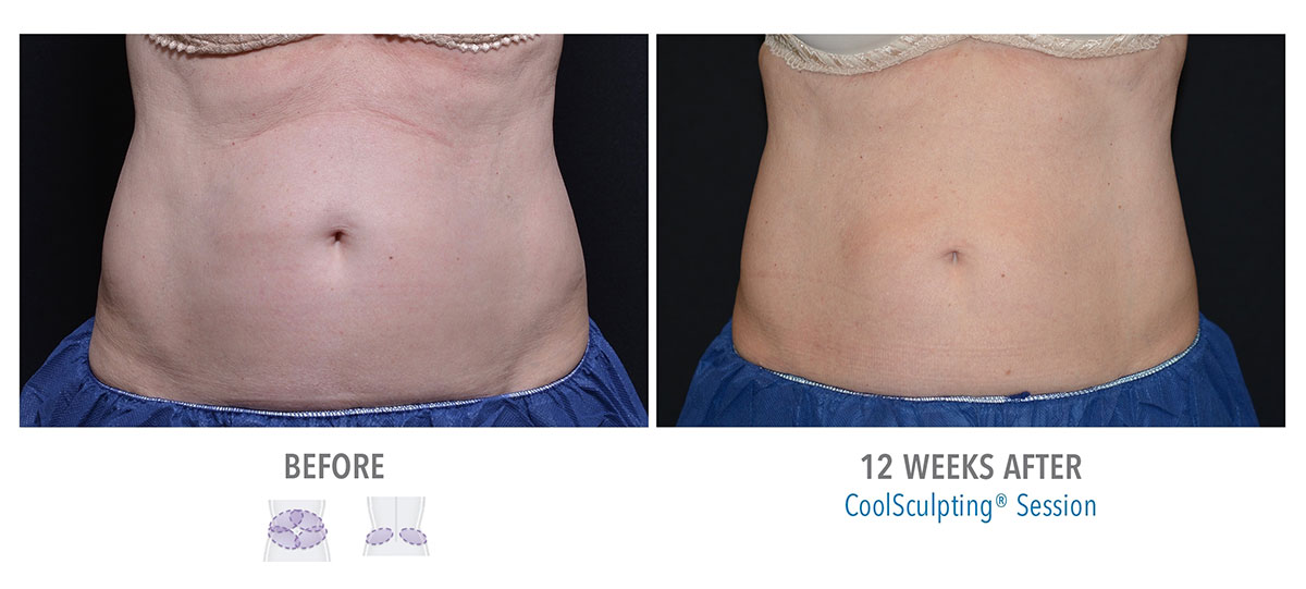 before and after coolsculpting