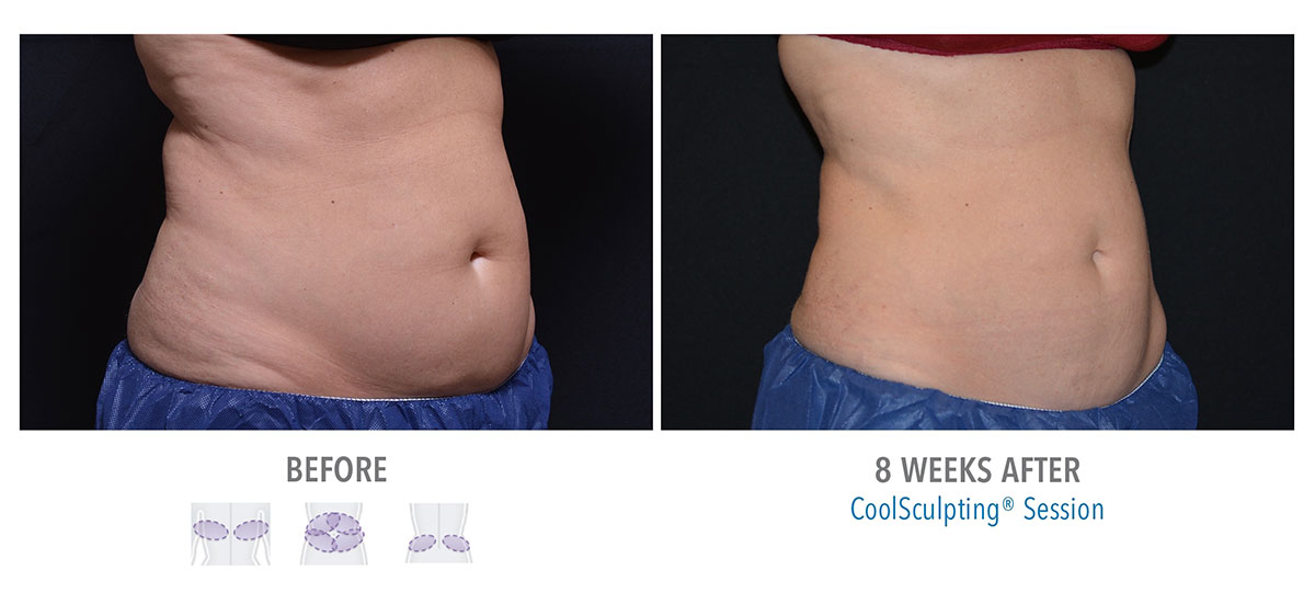 woman after coolsculpting for stubborn belly fat hendersonville