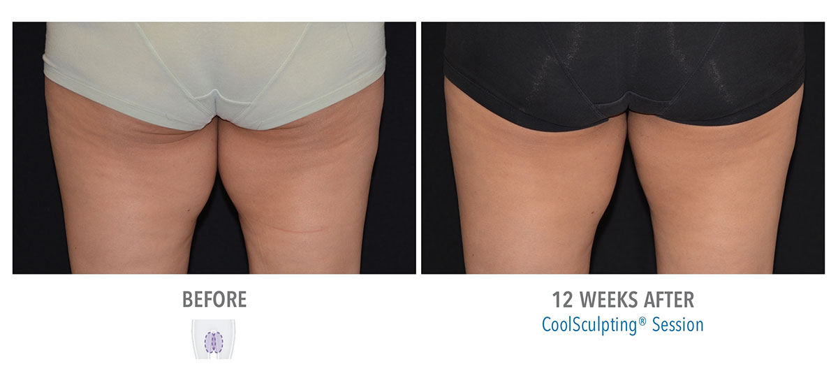 before and after coolsculpting for leg fat hendersonville