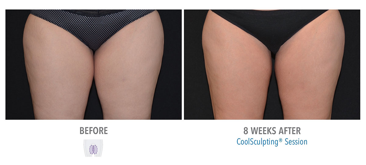 before and after coolsculpting