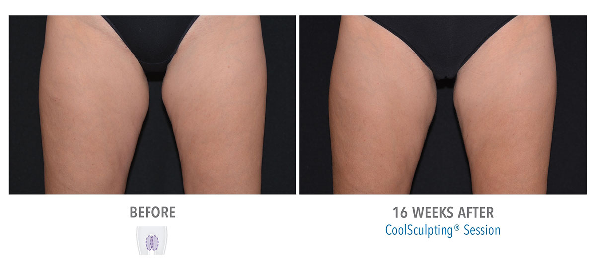 before and after coolsculpting