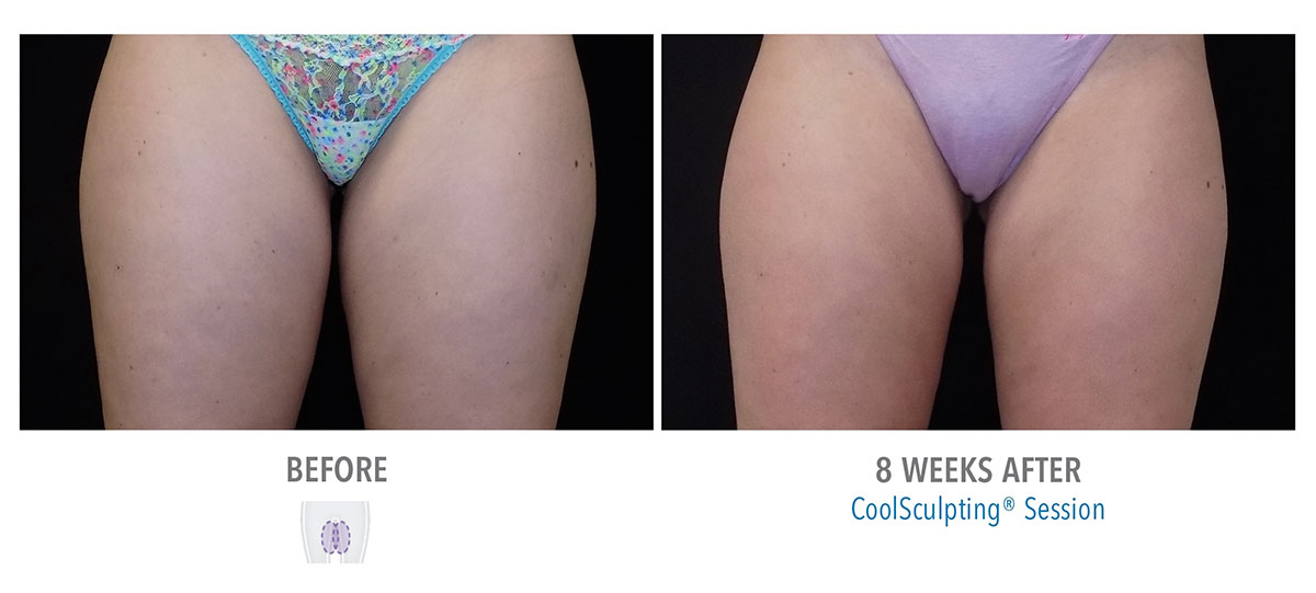 before and after coolsculpting for leg fat hendersonville