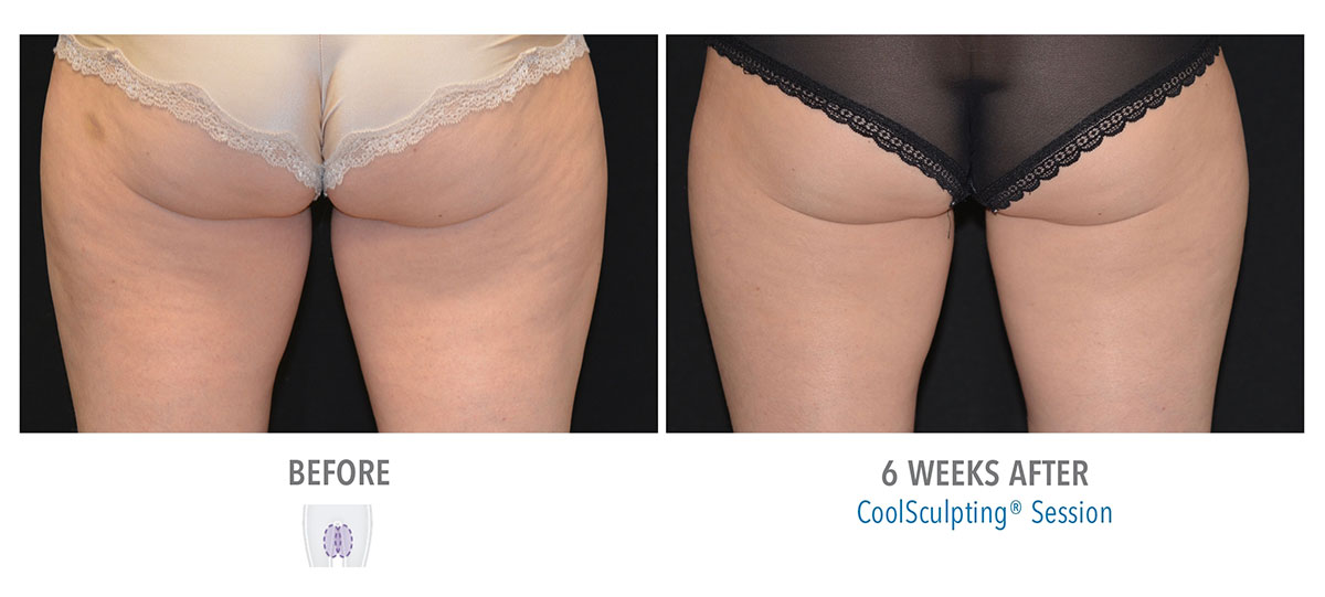 before and after coolsculpting