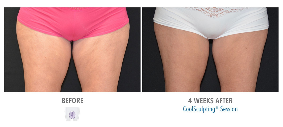 before and after coolsculpting