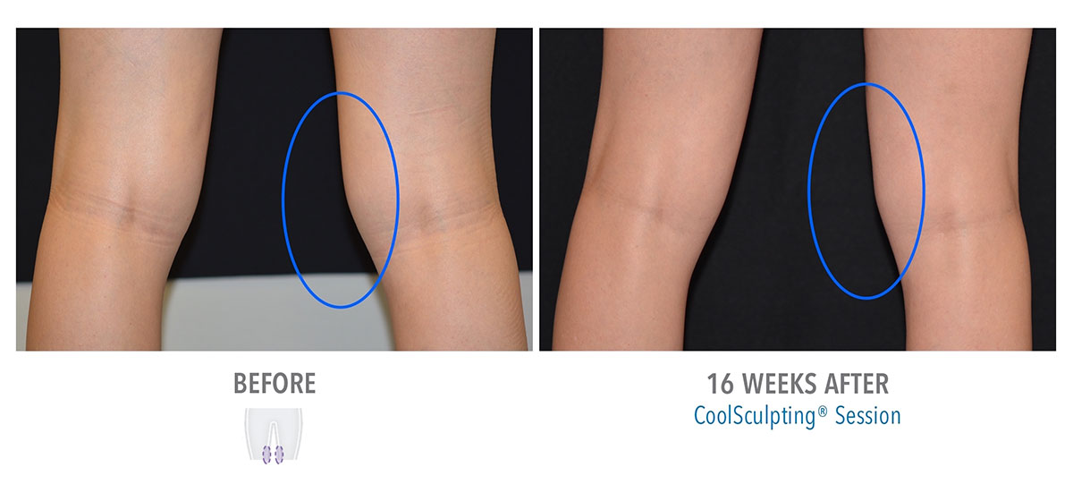 before and after coolsculpting