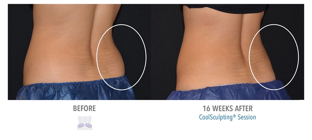before and after coolsculpting for love handles and muffin top hendersonville