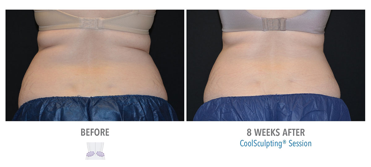 before and after coolsculpting