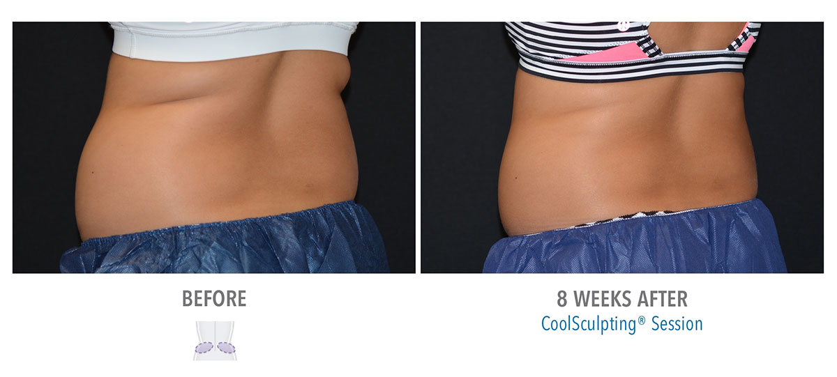 before and after coolsculpting