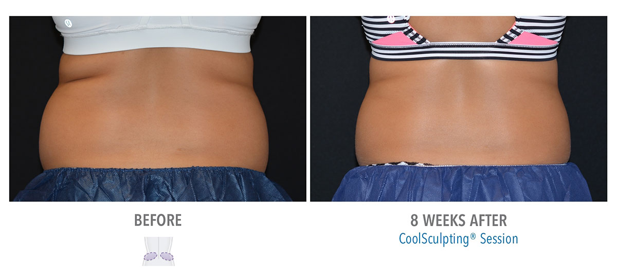 before and after coolsculpting for love handles and muffin top hendersonville