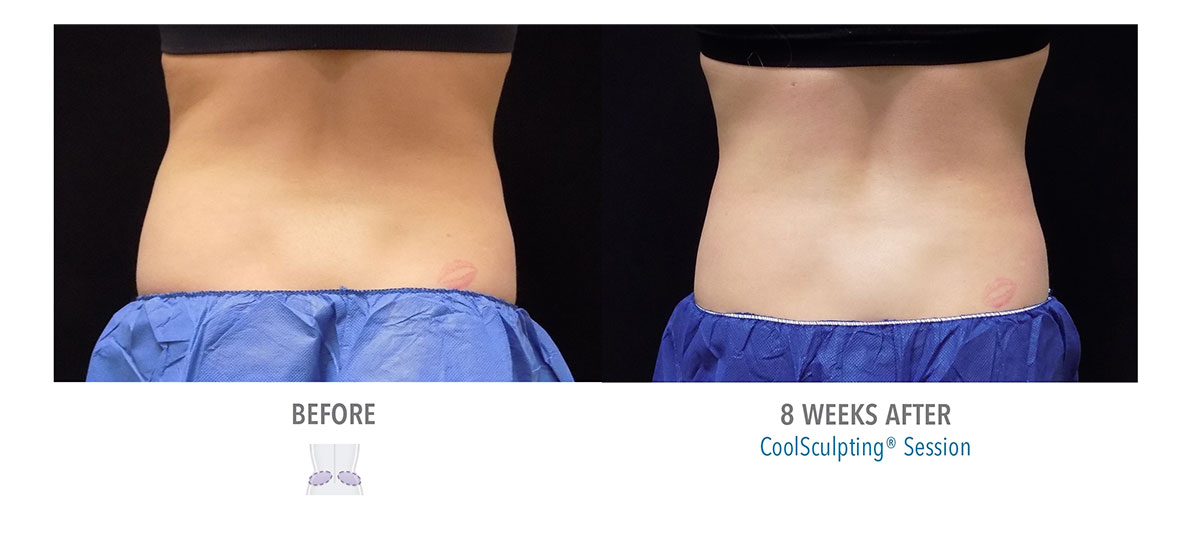 before and after coolsculpting