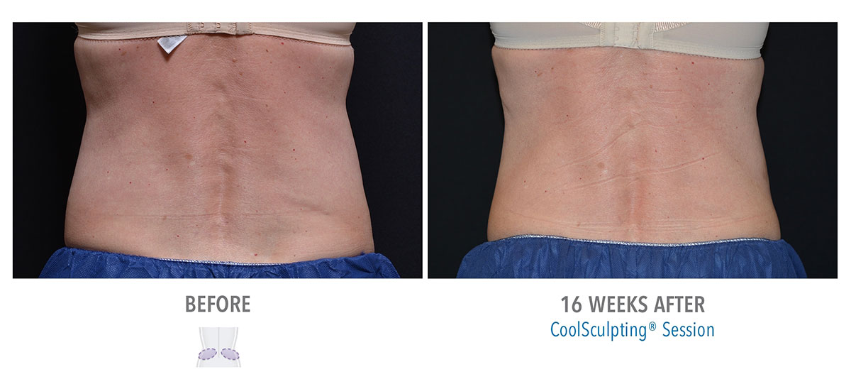 before and after coolsculpting