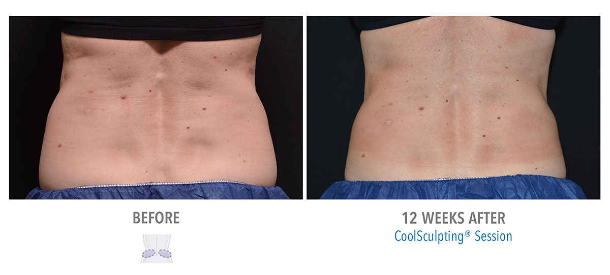 before and after coolsculpting for love handles and muffin top hendersonville