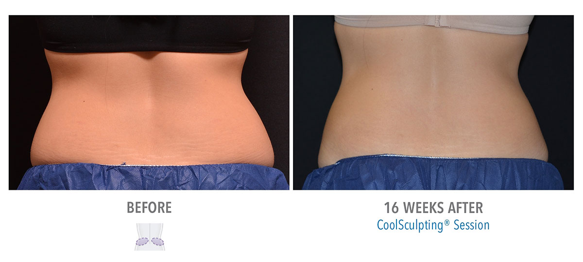 before and after coolsculpting