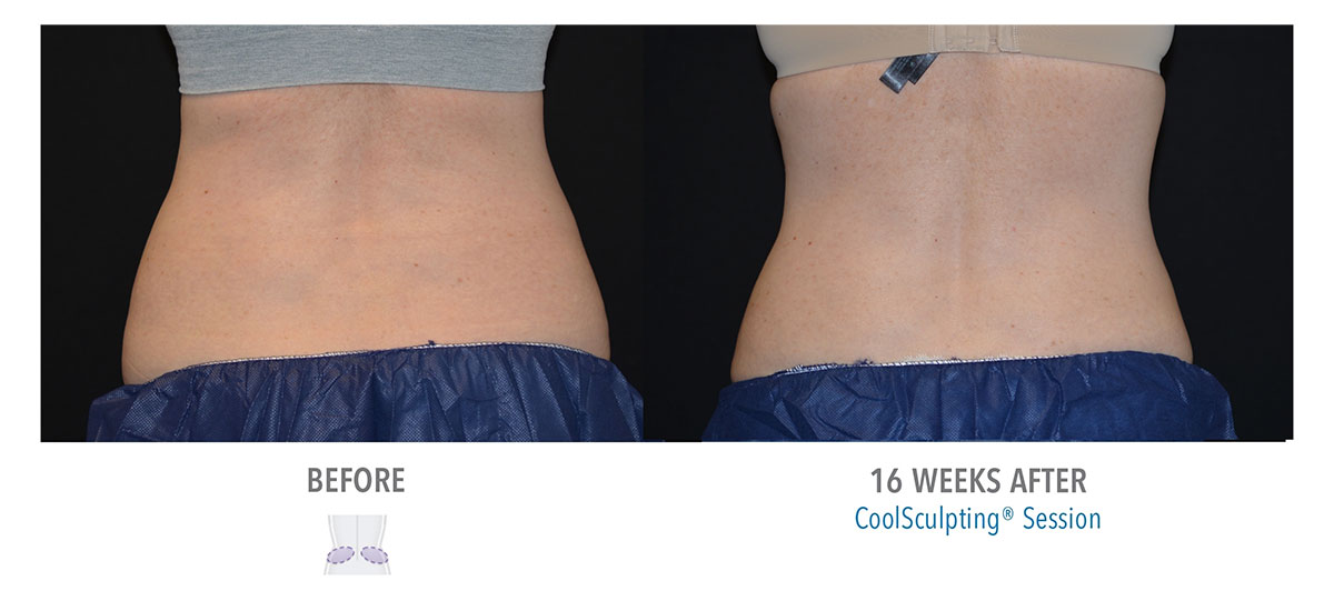 before and after coolsculpting