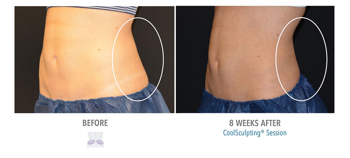 before and after coolsculpting for love handles and muffin top hendersonville