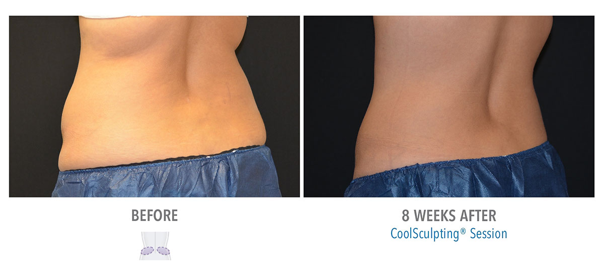 before and after coolsculpting